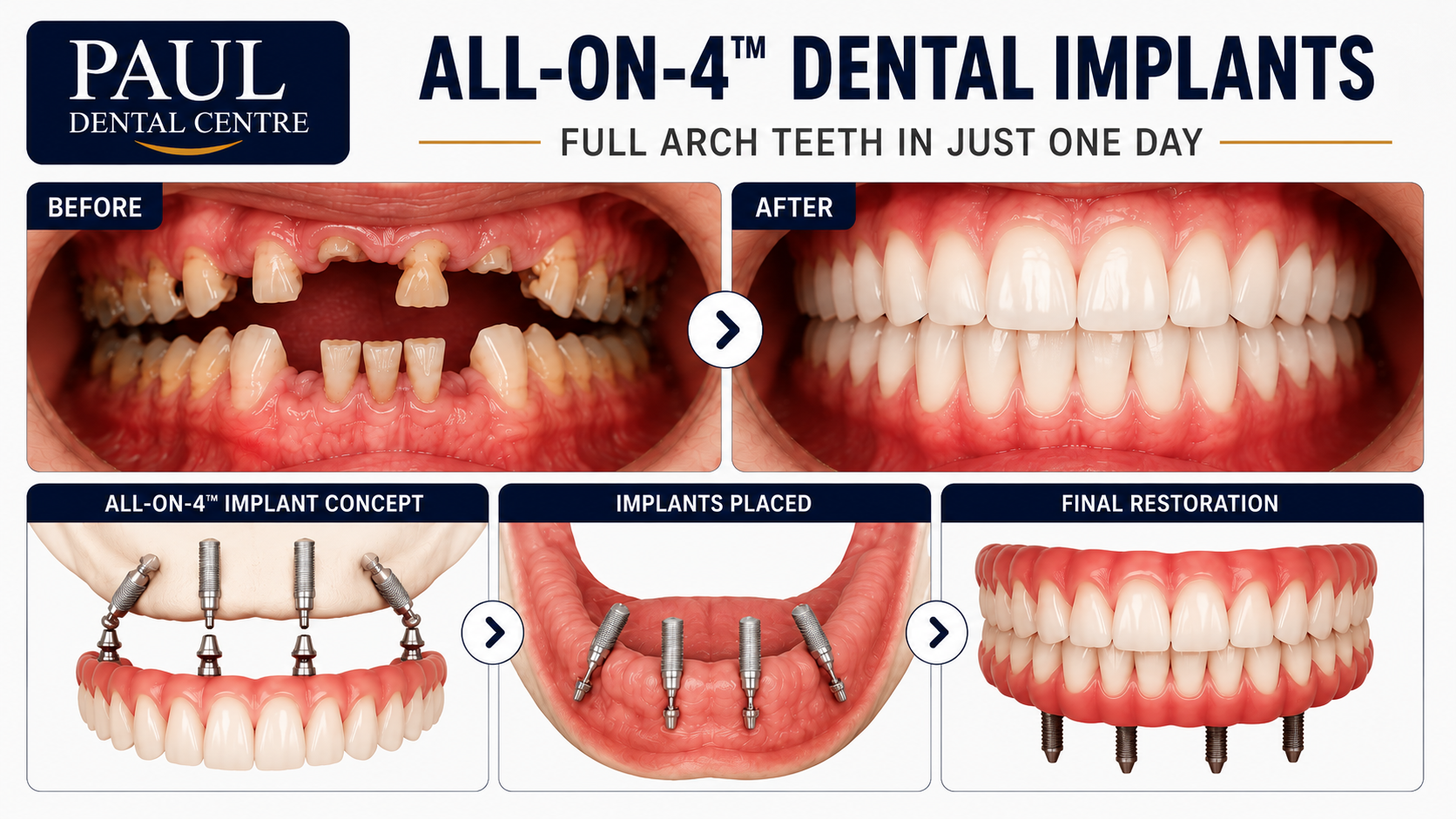 All-on-4 Procedure